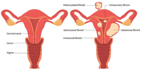 All You Need to Know About Uterine Fibroids Sg Vasular