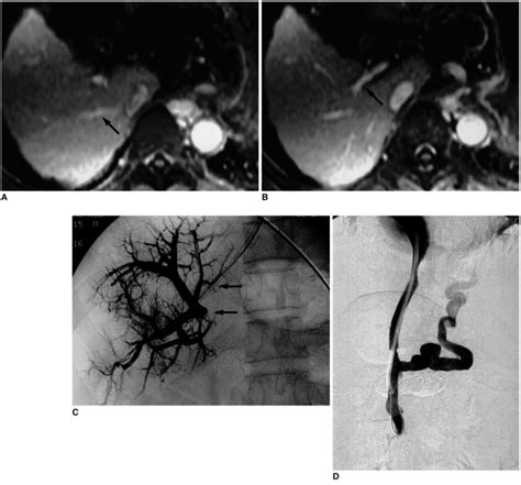 Case 2. A 41-year-old man with active variceal bleeding. A, B ...