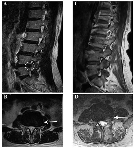 Giant intrapelvic malignant peripheral nerve sheath tumor mimicking disc herniation: A case report