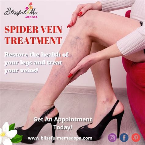 Spider veins treatment riverview using injection sclerotherapy – Artofit