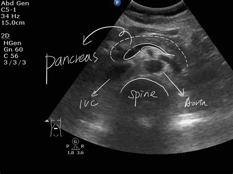 Splenic Vein Ultrasound