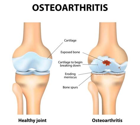 Knee Pain Treatment