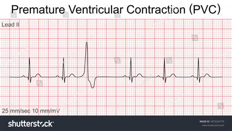 Premature Ventricular Contractions Vs Premature Atrial Contractions