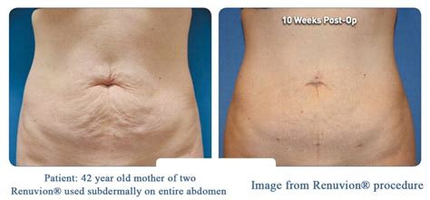 Renuvion J-Plasma Tightening Omaha - Omaha Liposuction by Imagen