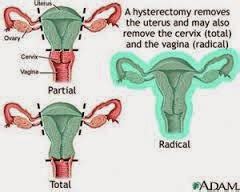 Medical Treatment Pictures-for Better Understanding: Abdominal myomectomy: Before & After