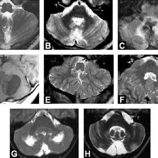 MRI of the cerebellum. (A) T1-weighted sagittal image of near complete ...