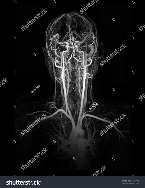 Mri Image Mra Show Head Neck Stock Photo 82426798 - Shutterstock