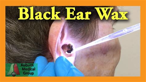 Black Ear Wax Removal | Auburn Medical Group - YouTube