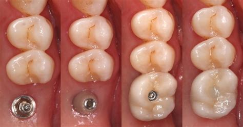 A Guide to Healing Abutments - Brighton Implant Clinic : Dental Implants