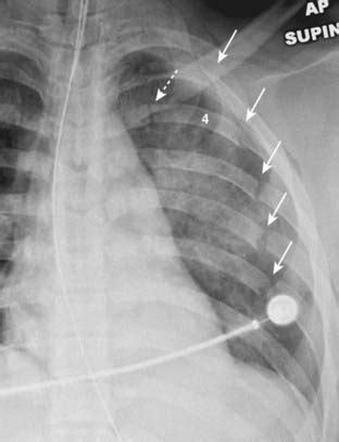 Recognizing the Imaging Findings of Trauma | Radiology Key