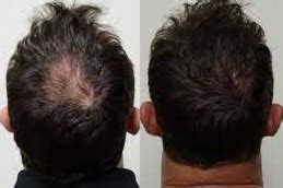 Biofibre Hair Transplant in Islamabad, Rawalpindi & Pakistan | Cost