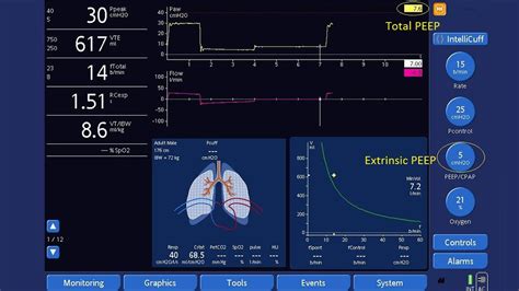 Measurement of AutoPEEP and total PEEP | Hamilton Medical