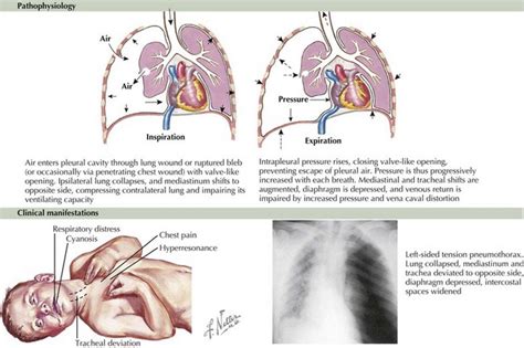 Pleural Effusions and Pneumothorax | Clinical Gate