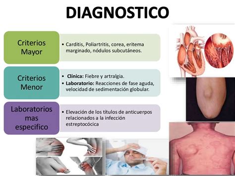 Fiebre reumatica