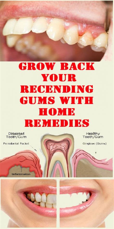 Gum recession is the medical term describing when the margin of gum tissue surrounding the tooth ...