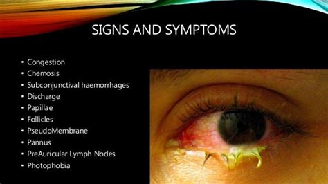 Management of Conjunctivitis