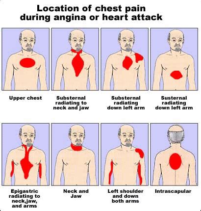 Heart attack | Health24