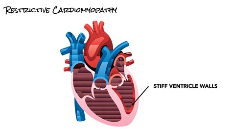 Restrictive Cardiomyopathy | SCAI - Seconds Count