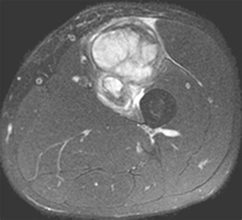 Soft Tissue Sarcoma - Pathology - Orthobullets