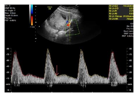 Transabdominal Doppler interrogation of the uterine artery at the level ...