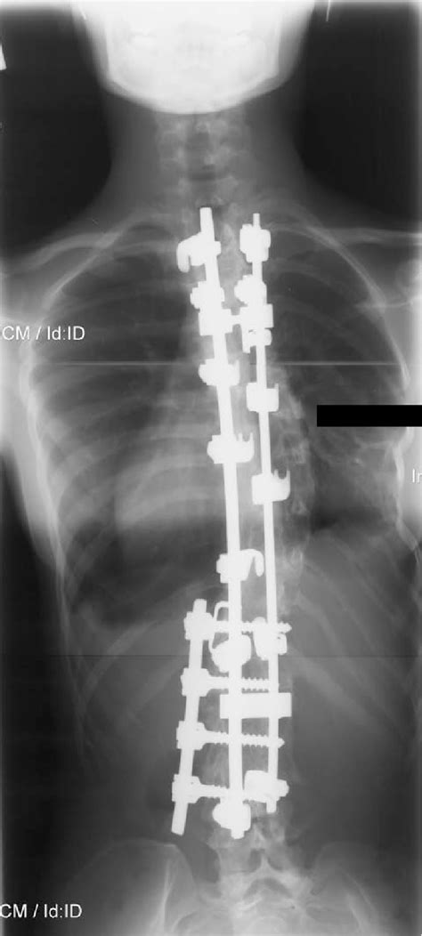 x-ray, showing location of the Harrington rods. | Download Scientific ...