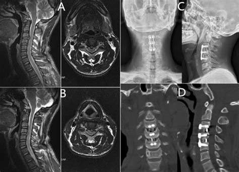 a, b Magnetic resonance imaging reveals C3/C4 and C4/C5 dural sacs and ...