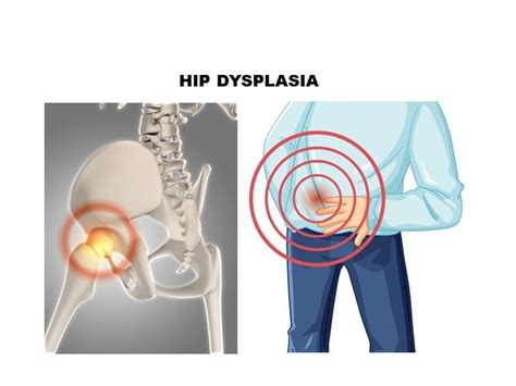 Hip Dysplasia Causes Symptoms & Treatment | Dr. Praharsha