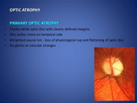 Optic disc evaluation