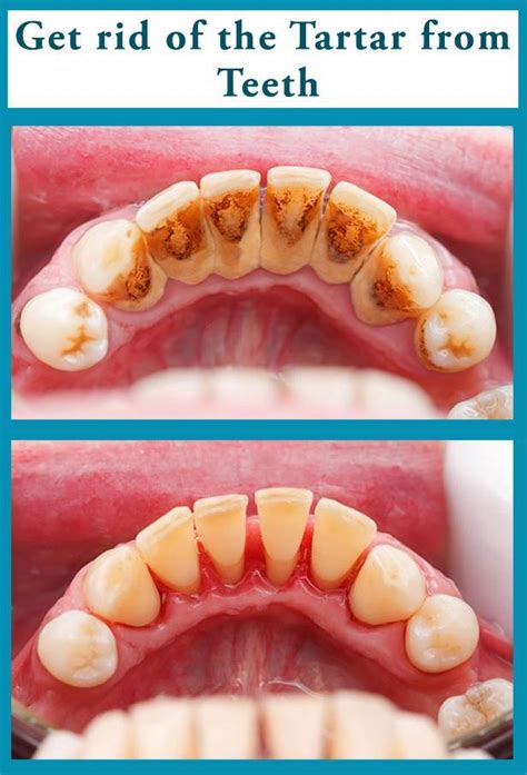 Here Is How You Can Remove Tartar At Home Without Visiting the Dentist | ThatViralFeed