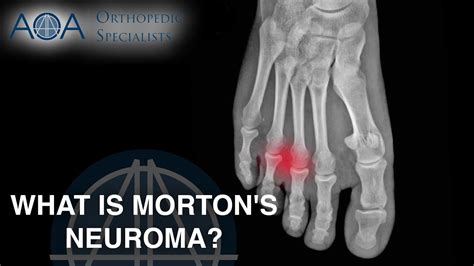 Morton's Neuroma Histology