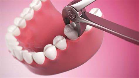 Why You Shouldn’t Avoid a Tooth Extraction - Caputo Dental
