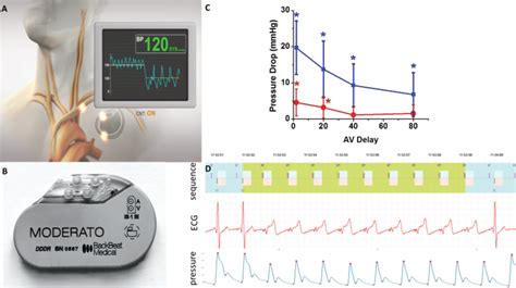 Cardiac neuromodulation therapy BackBeat. (A,B) Implantable pulse ...