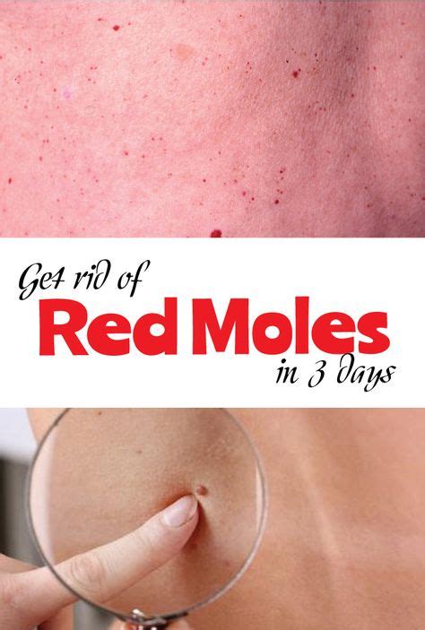 Get rid of Red Moles in 3 Days | Health and beauty tips, Skin moles, Home remedies