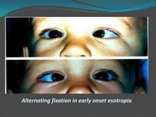 Accommodative esotropia | PPT