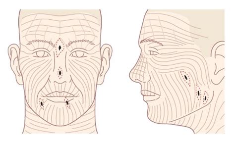 skin-tension-lines-face - https://skinoncology.ru