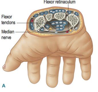 Carpel Tunnel Release - Opening of the Flexor Retinaculum