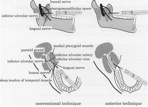 INJECTION SITES | Odontology | Pinterest