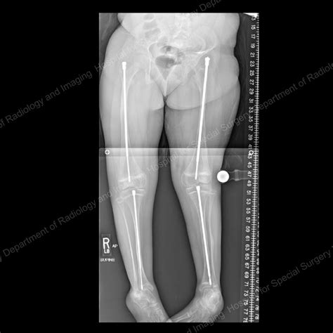 Osteogenesis Imperfecta: Approaches for Treating Children