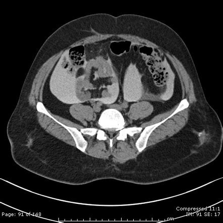 Intraperitoneal bladder rupture | Image | Radiopaedia.org