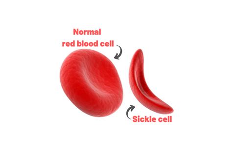 World Sickle Cell Day 2020: What is Sickle Cell Disease? Regency Hospita