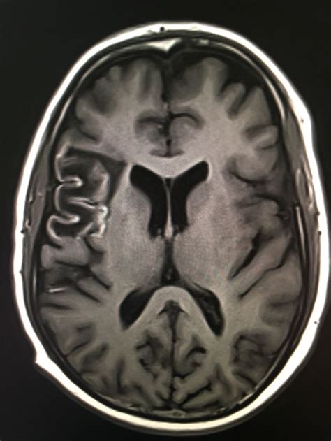 Cortical laminar necrosis