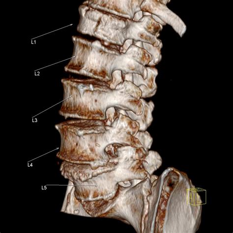 L1 Compression Fracture What Is An L1 Compression Fracture A Closer ...