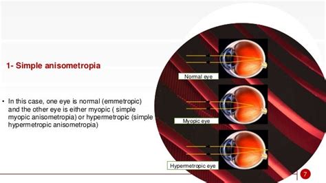 Anisometropia