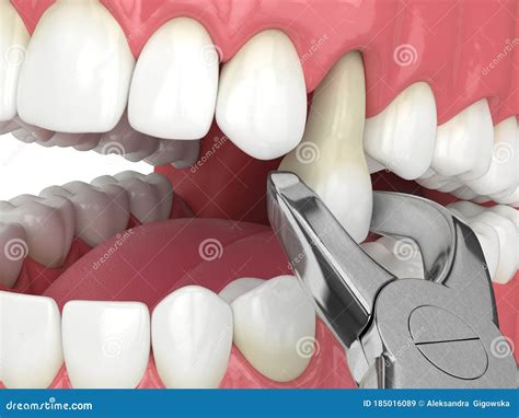 3d Render of Lower Jaw with Tooth Extraction Stock Illustration ...