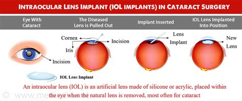 Intraocular Lens Implants (IOL) - Types, Procedure, Recovery & Complications