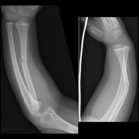 Pediatric Galeazzi Fracture Dislocation | Pediatric Radiology Reference ...