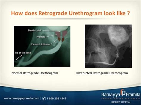 Retrograde urethroscopy