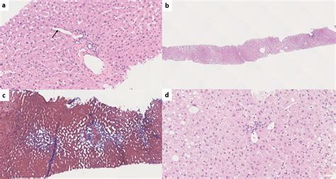 Portal Hypertension Histology