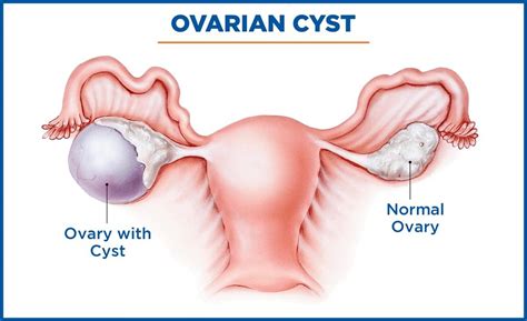 Causes, Symptoms and Treatment of Ovarian Cyst