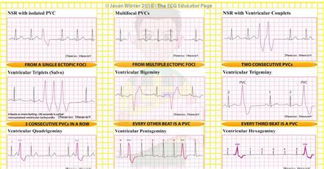 ECG Educator Blog : Ventricular Ectopics